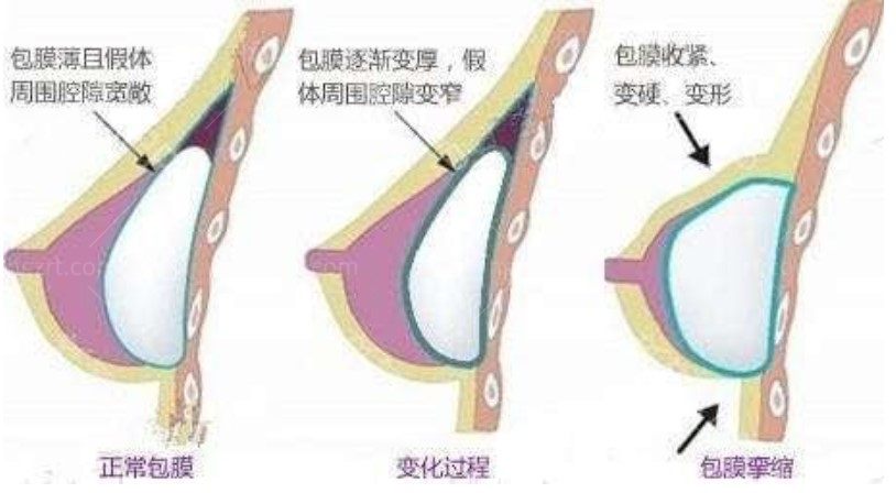 假体隆胸过程变化照片