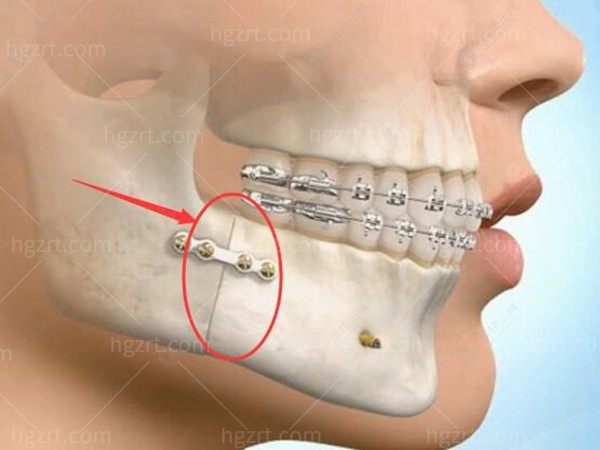 正颌直术的条件是什么?如果正颌直术术后不正畸有影响吗?