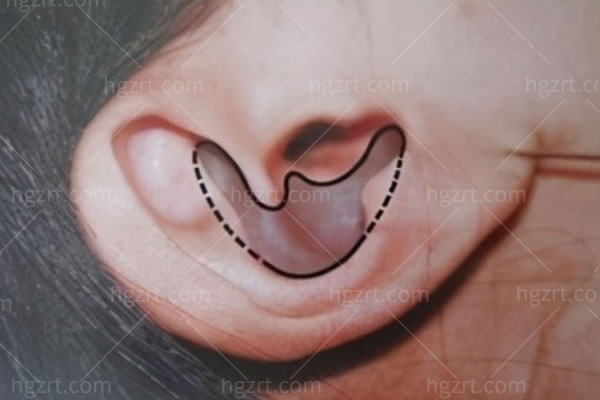 耳软骨隆鼻可以维持多久