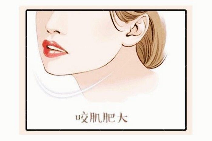 千万别做射频瘦咬肌