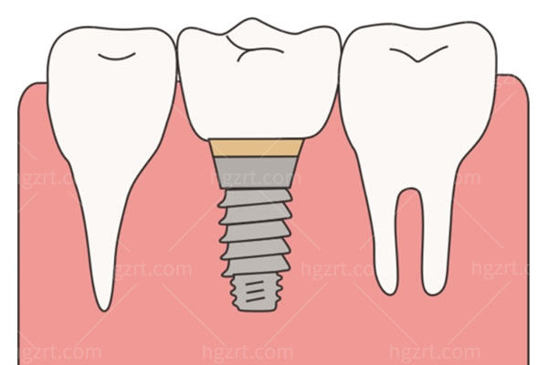 1颗种植牙
