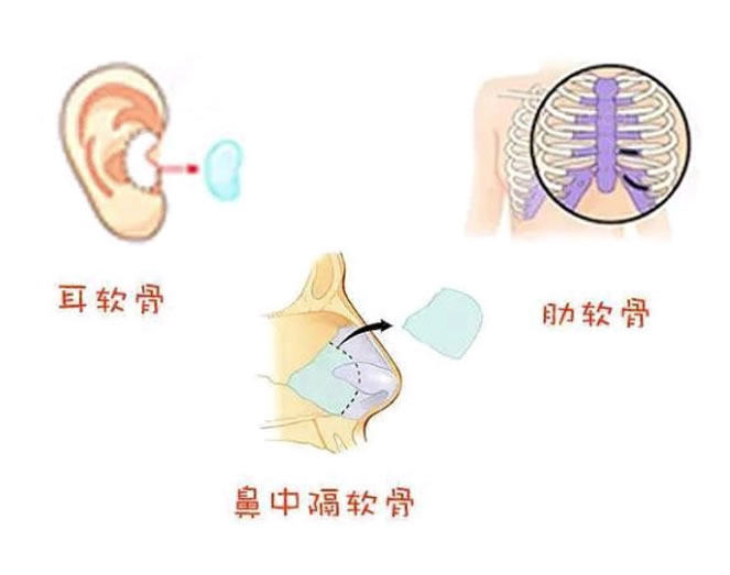 耳软骨、肋软骨卡通照片