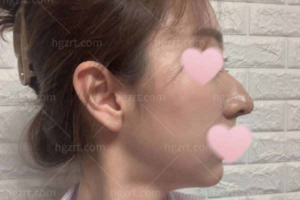 记录我在韩国做鼻部整形全过程