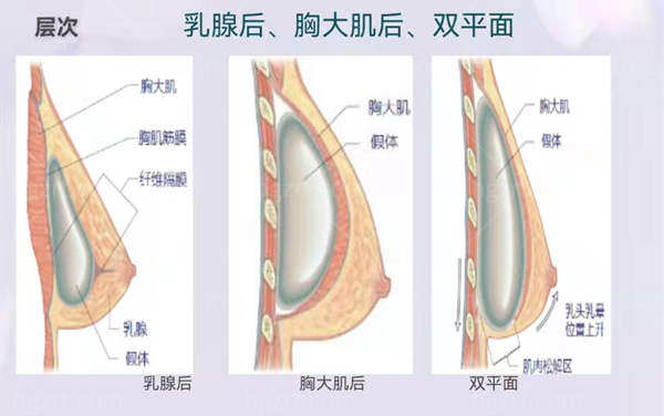 隆胸手术