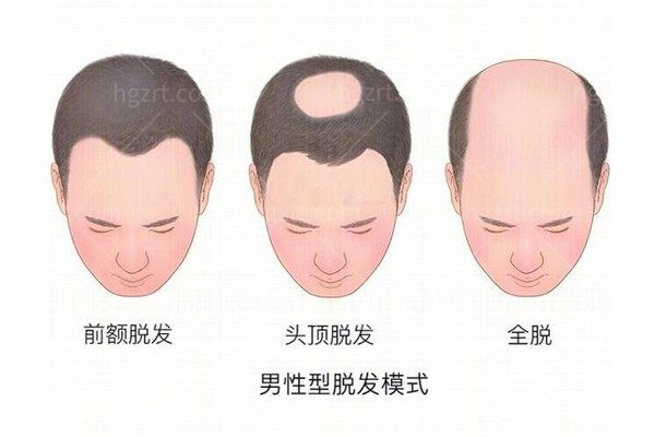 广州种植头发哪个医院好？网友认可的植发医院排名榜top5盘点