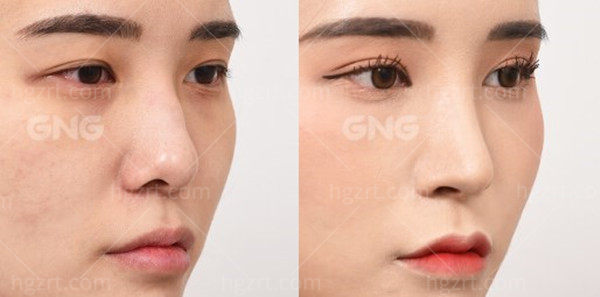 定制鼻前后对比