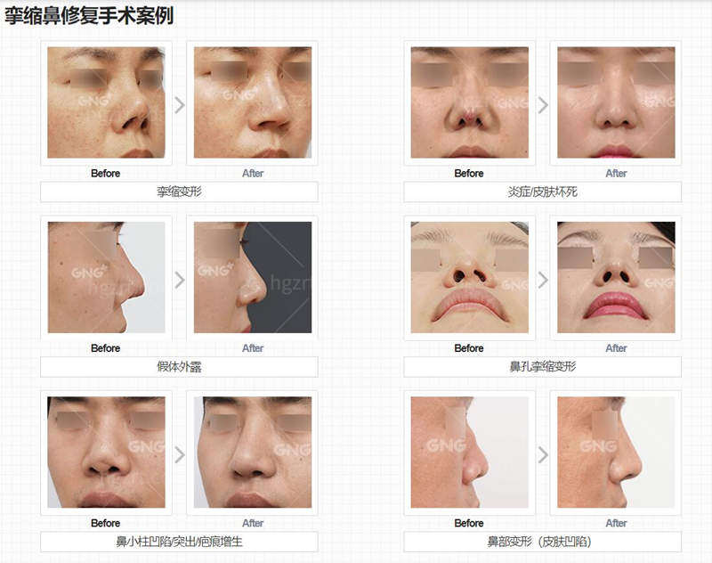 韩国GNG医院鼻修复病例