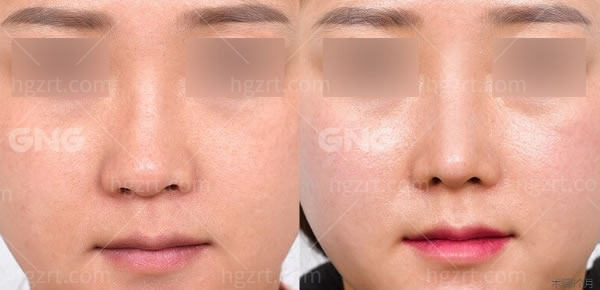 必看蒜头鼻隆鼻对比照片,看过后也想去正规的韩国gng医院隆鼻 _整容通