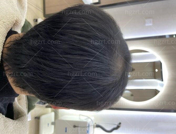 植发术后图
