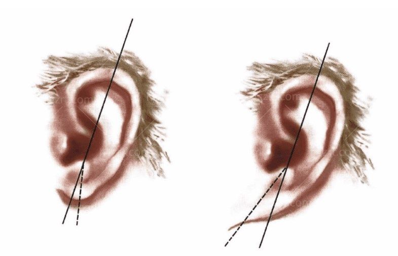 拉皮术后变形的耳垂