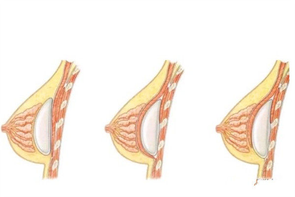 隆胸假体的过程