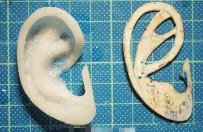 小耳畸形3D打印技术和传统手术相比