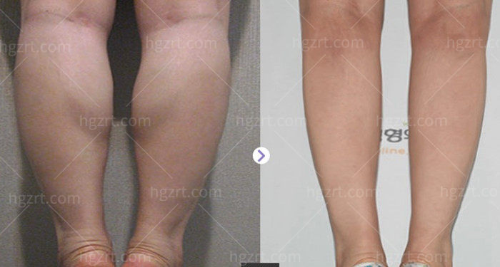 小腿肌肉放松术—术前术后对比