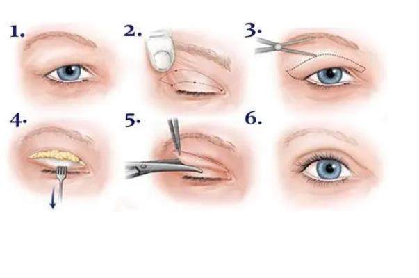 全切双眼皮手术