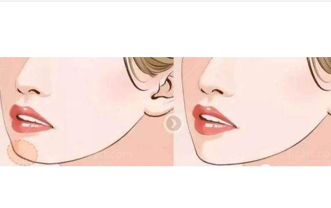 自体脂肪垫下巴