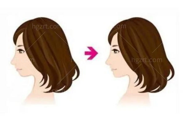 垫下巴前后对比