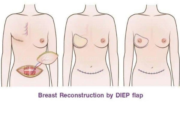 自体组织乳房再造