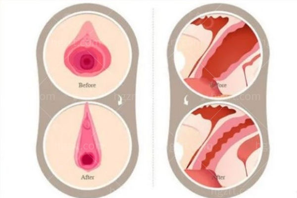 手术缩紧阴道/手术缩阴