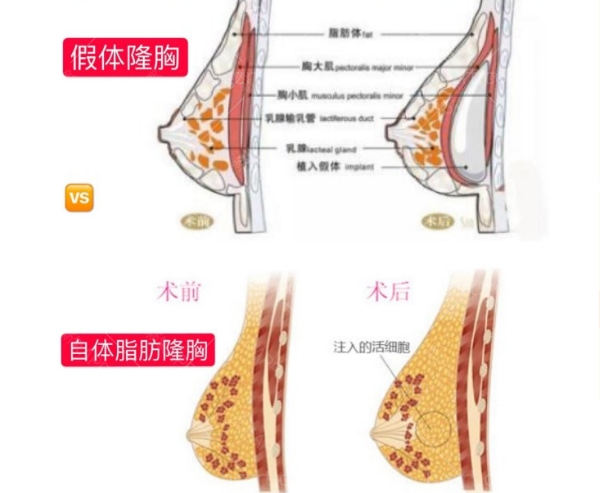 自体脂肪丰胸VS假体隆胸术后对比