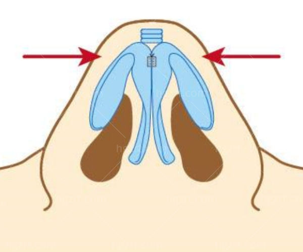 软骨隆鼻会吸收变形吗怎么办?鼻子的类型和相应的手术