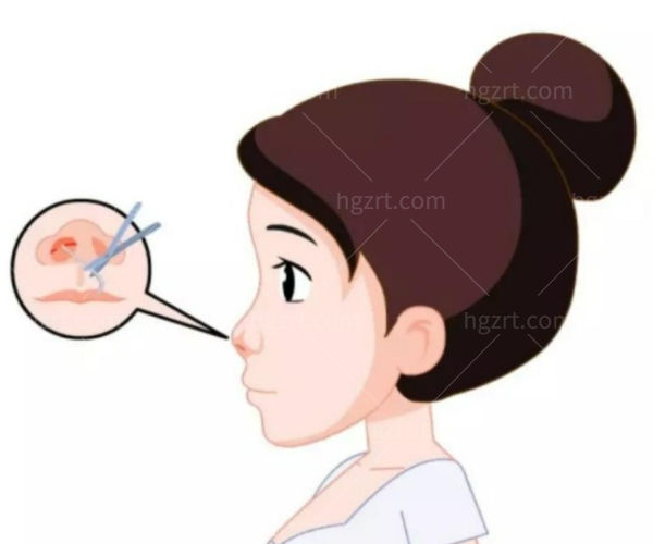 软骨隆鼻会吸收变形吗怎么办?鼻子的类型和相应的手术