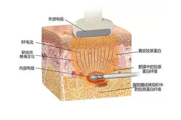 激光溶脂