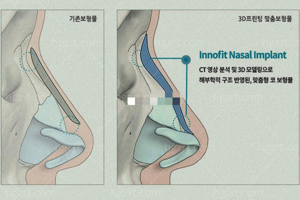 鼻中隔重建难度大吗?看韩国GNG医院成龙海/洪晟文院长怎么做?