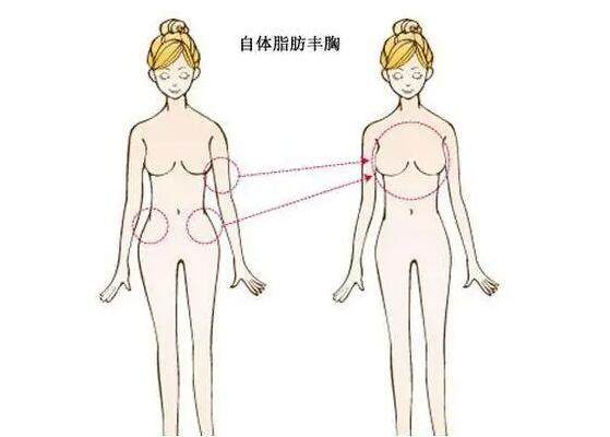 自体脂肪丰胸手术费要多少钱?影响自体脂肪隆胸价格的3个因素