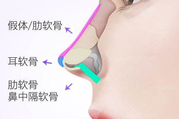 假体隆鼻机构图