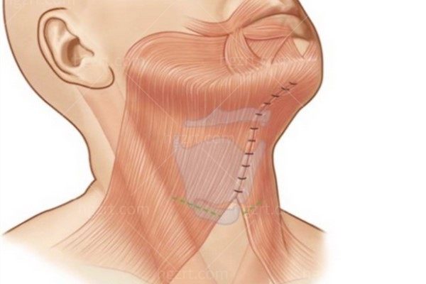 颈阔肌成形术医院哪家好?整友力推王志军颈高位smas除皱+阔肌成形术