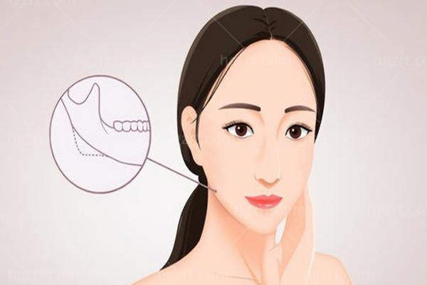 下颌角手术后悔死了