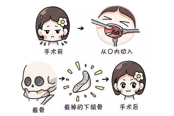 下颌角手术后悔死了