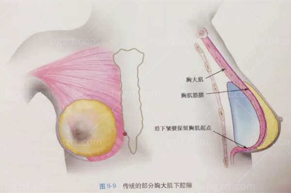 胸大肌下放置假体隆胸的特点
