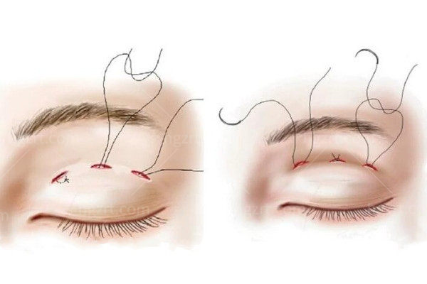 倒睫手术和双眼皮手术一样吗?详细的倒睫和双眼皮手术知识分享