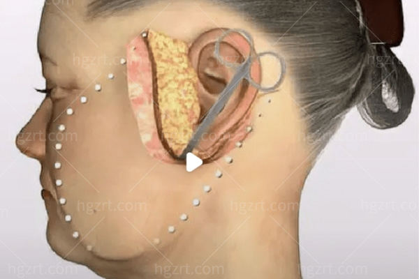 耳前切口面部提升图片 和大拉皮相比哪个好？