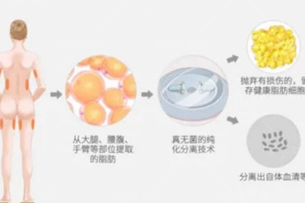 隆胸会影响以后喂奶吗？想做隆胸的我一直在犹豫不决