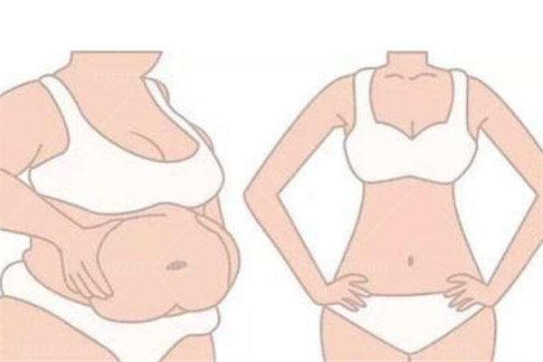 腹壁成形术前后对比