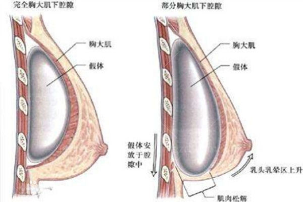 隆胸假体较好的植入位置