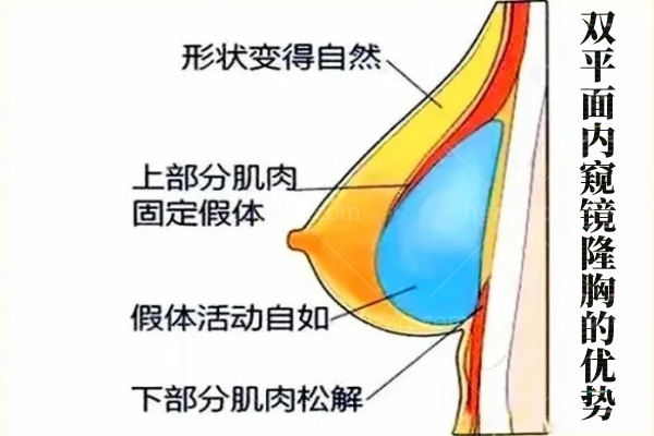 双平面内窥镜隆胸的优点