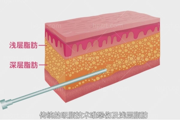 水动力吸脂的优缺点有哪些