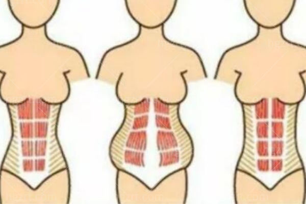 腹壁成形术和腰腹抽脂对比哪个好