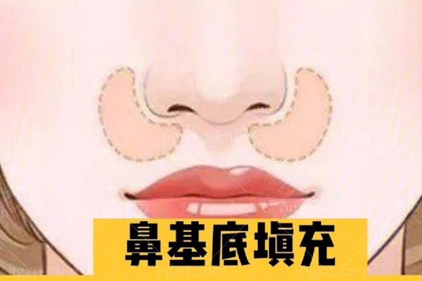 鼻基底凹陷填充用什么材料好