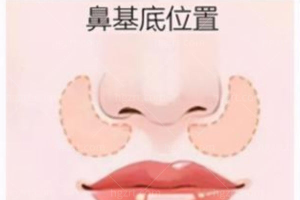鼻基底凹陷填充用什么材料好