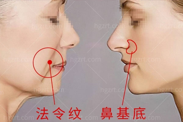 鼻基底凹陷填充用什么材料好