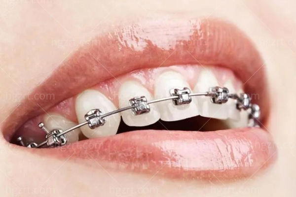 高考带牙齿矫正器能进考场吗