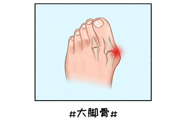 马桂文做大脚骨手术怎么样
