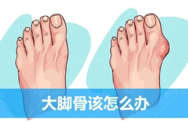 北京哪家医院做大脚骨做得好