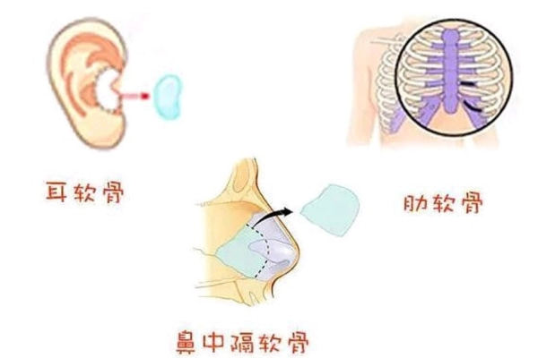 耳软骨隆鼻和肋骨隆鼻有什么区别