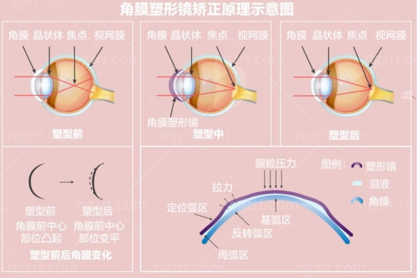 角膜塑形镜和近视防控眼镜哪个好