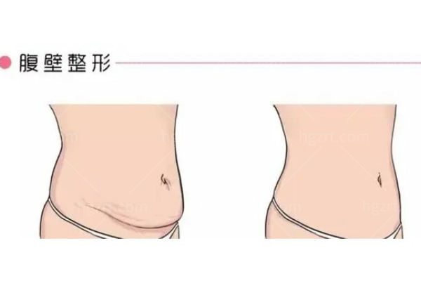 腹壁成形术1.jpg